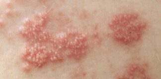 Con giời leo là gì? Cách nhận biết và điều trị bệnh giời leo Khi bị con giời leo cắn sẽ gây nên những vết phồng rộp trên da