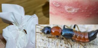 Kiến ba khoang đốt cần làm gì? Cách xử lý nhanh nhất Những triệu chứng khi bị kiến ba khoang cắn