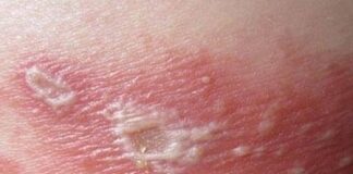 Dấu hiệu khi bị kiến ba khoang cắn và cách xử trí an toàn Xử trí khi bị kiến ba khoang đốt